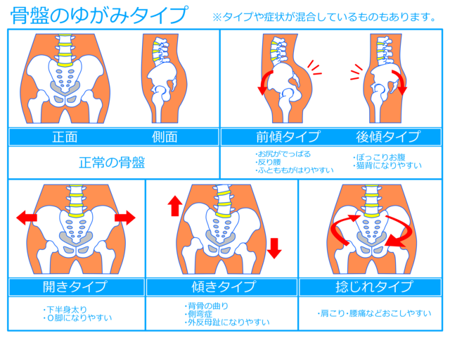 骨盤の歪みタイプ図解