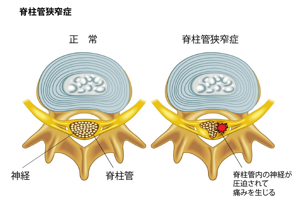 脊柱管狭窄症図解