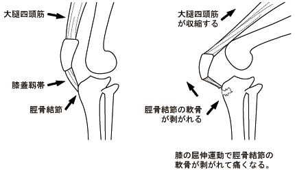 オスグッド病図解